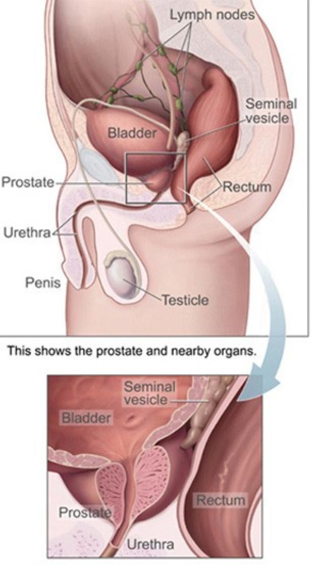 Introduction How Common Is Prostate Cancer? Prostate cancer is the most common cancer, other than skin cancer, in American men and is the second leading cause of cancer death in men.