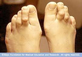 Also called hammertoes, toes