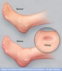 Swelling; the presence of an abnormally large amount of fluid in the tissue of the body Examples shown here: - Lower left