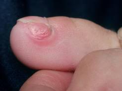 Bone spur projected upward under the nail Often the cause