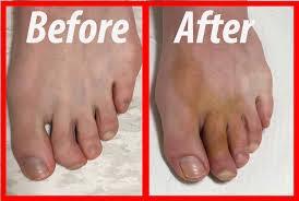 The cutting of a tendon for correction of hammertoes/contracted toes When hammertoes are flexible and not rigid, a procedure referred to as a