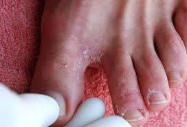 Layman s term ( Athlete s Foot ) for a fungal infection of the