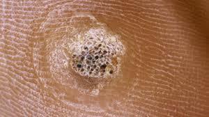 A tumorous growth of the skin More commonly referred to as a wart, and caused by a virus The body works to protect the