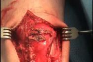 Following medial and lateral parapatellar incisions,