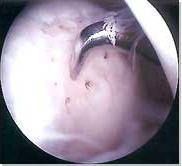 fractures, resulting in fibrocartilaginous