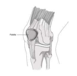 The outer (lateral) half is pulled through under the inner (medial) half and attached to the tibia, pulling the patella over to the medial side.