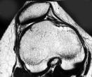 Patellar Instability Lateral patellar subluxation or dislocation knee flexion tibial external rotation valgus