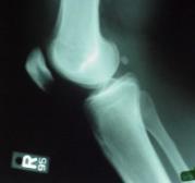 Patellofemoral Problems Differentiate between pain and instability Instability: -Provide pt with a patellar sleeve,