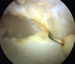 Lateral Release Arthroscopic or open For LPCS NOT for general anterior knee pain Not for instability Isolated releases should be performed infrequently