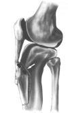 stability Fair results regarding decreasing patellofemoral pain Less favorable results if x-ray evidence of arthrosis Patellar Instability Proximal Soft