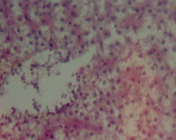 Normally arranged hepatocytes with no glycogen and intercellular fat deposition