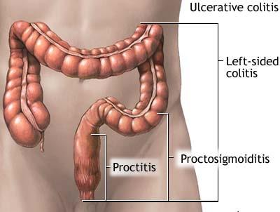Surgical Complications Bleeding 2-5% Infection 2-10% Breakdown of anastomosis 2-4% Injury to neighboring structures Ulcerative Colitis Ulcerative Colitis Affects large intestine (colon) Inflammation
