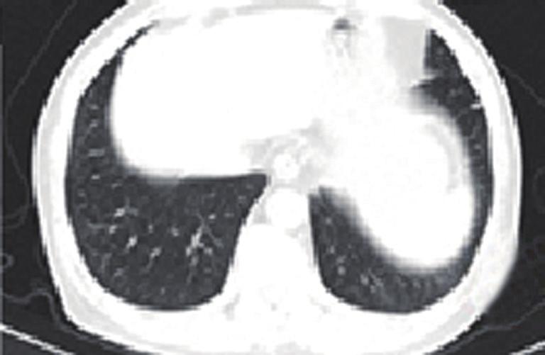 The patient took further five times chest CT in two month intervals thereafter to June 2014, main mass was reduced to 1.