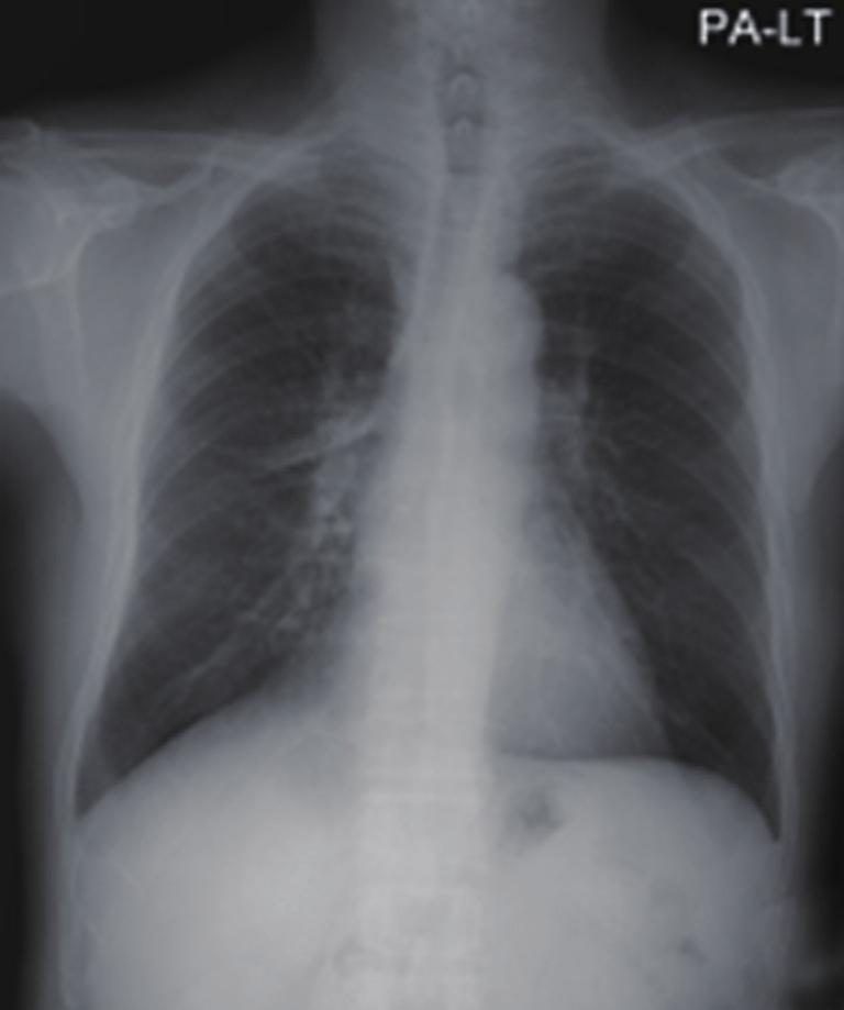 Journal of Thoracic Disease, Vol 8, No 3 March 2016 E237 A B C D E F Figure 2 (A-C) Chest X-ray and computed tomography (CT) which were taken on April 2013; (D-F) chest X-ray and CT on