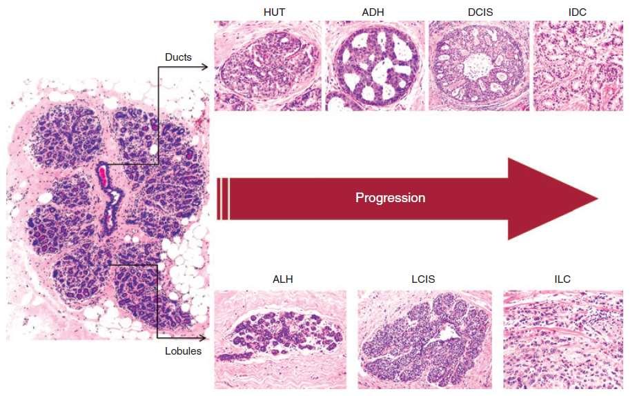 Spectrum of Benign Breast Disease Non-proliferative lesions Proliferative lesions w/o atypia ADH DCIS IDC Epithelial hyperplasia Intraductal papilloma Sclerosing adenosis Radial scar RR 1.5-2.
