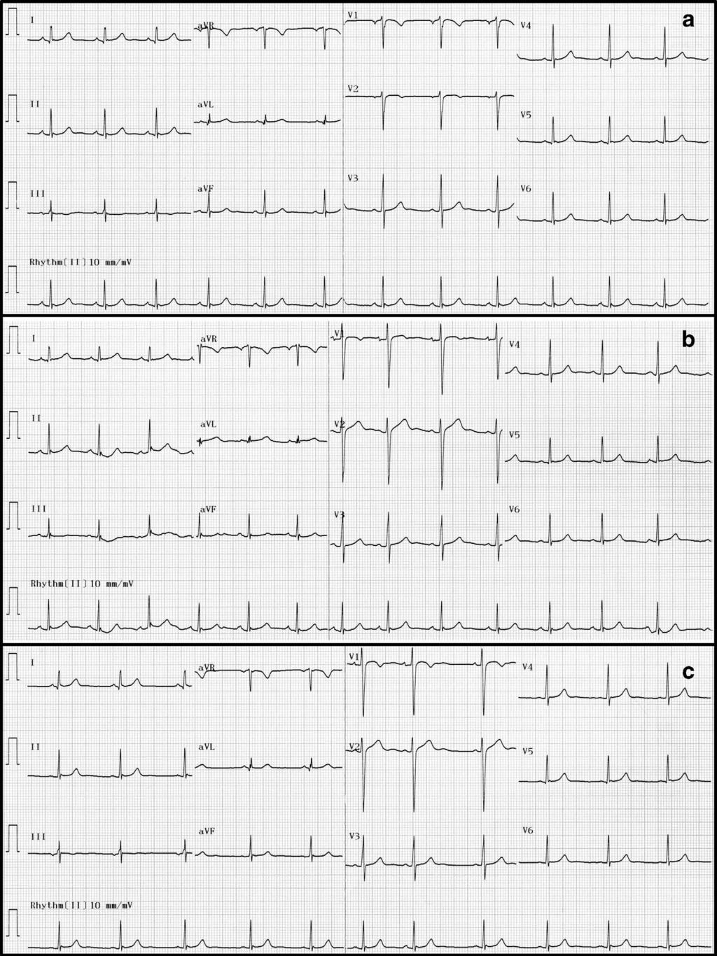 4 Figure 2 Repeat ECGs for the S422L homozygous sibling. (a) Twelve-lead ECG with V1 and V2 leads placed at the left and right second intercostal spaces, respectively.