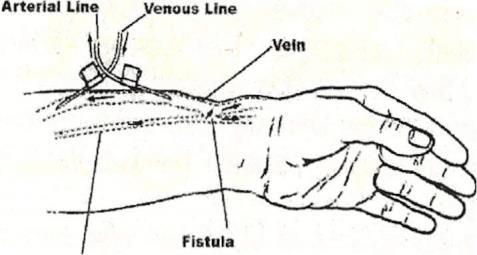 The connection between the two blood vessels is called the AV fistula.
