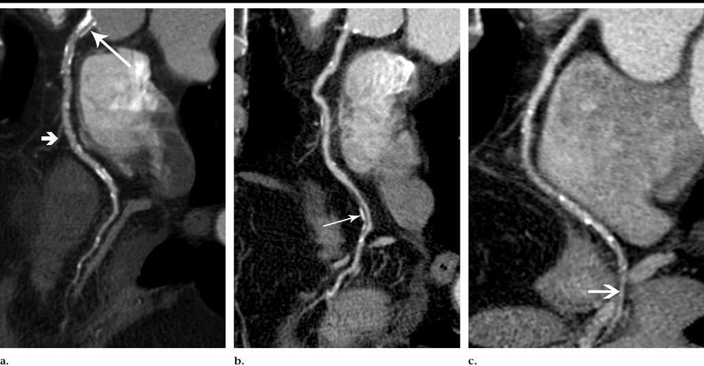 Figure 3. Curved MPR images of right coronary artery.