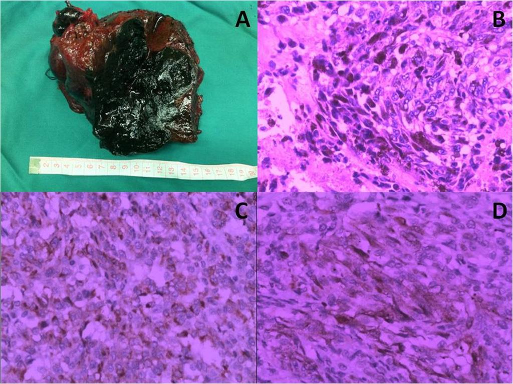 Postoperative immunostaining of the liver tumour established the diagnosis of malignant melanoma; the tumour was focally strongpositive for HMB45 and diffuse-positive for S100 (Figure 2C,D), with no