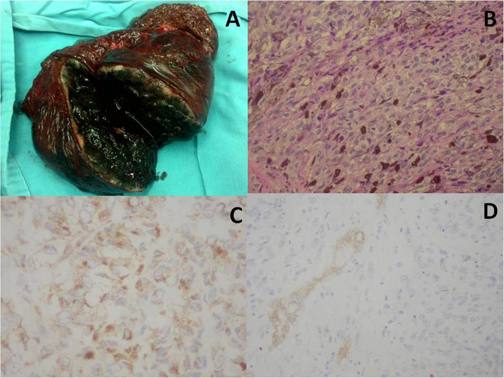 Zhang et al. World Journal of Surgical Oncology 2014, 12:362 Page 4 of 5 Figure 4 Pathological findings of case 2.