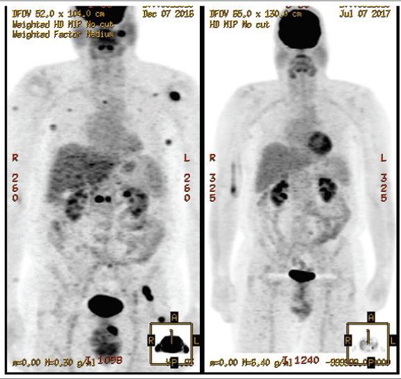 Multiple PET Scan-Detected Melanoma Deposits Resolved Baseline Day 169 Multiple tumors