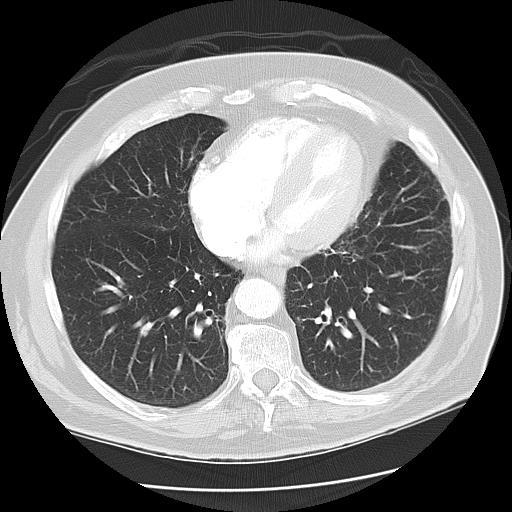 Lung Melanoma