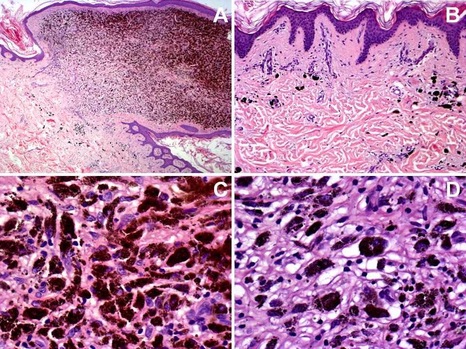 Histopathology of cutaneous biopsy at week 56 Haematoxylin and eosin staining depicting strong regressive changes both in flat and nodular
