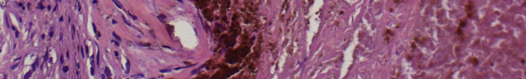 fibroblats with rare lymphocytes
