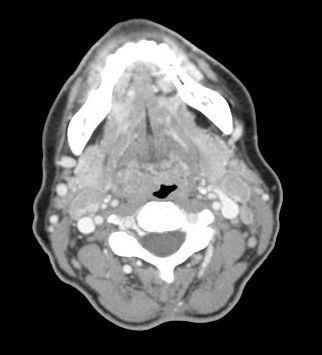 CLINICAL CASE W20 60-year-old Female Affected by Stage III Melanoma
