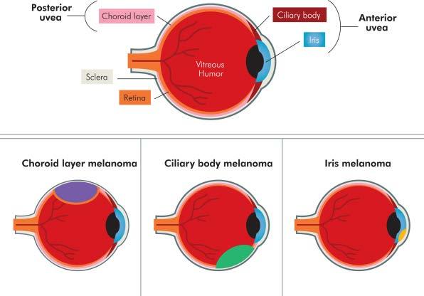 Uveal Melanoma <3% of melanoma Arising from the choroid, iris or ciliary body Upto 50% of pts develop