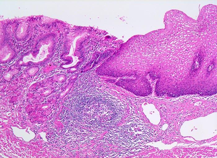 Metaplasia of oesophageal stratified squamous epithelium to glandular cells due to