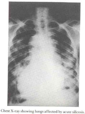 Chest X-rays