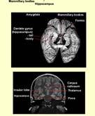 in diffuse areas of cortex
