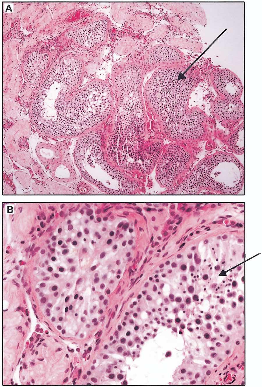 FIGURE 1 Examples of mixed testicular histology that resulted in changes in clinical care.