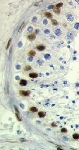 458 Diagnostic Tools ts ts b ts ts a c d Fig..51a d. Immunohistochemistry of Sertoli cell differentiation.