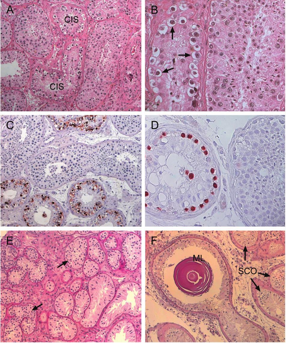 R.I.McLachlan et al. Figure 5. Testicular neoplasia at the carcinoma in situ (CIS) stage and dysgenetic features.