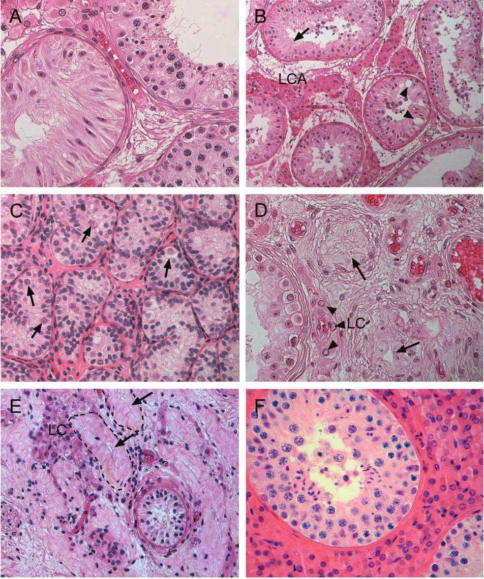 Histological evaluation of the human testis Figure 3. Mixed phenotypes and special features.