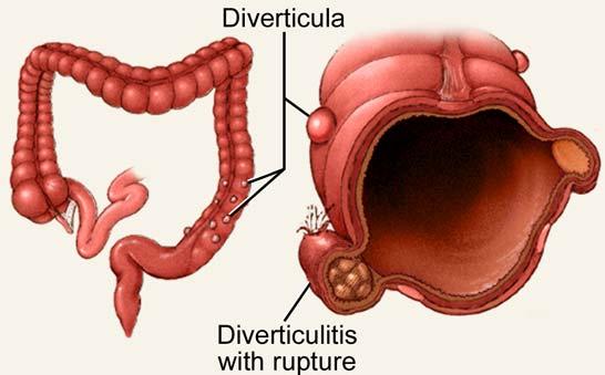Rectum Last section of colon (large intestines)