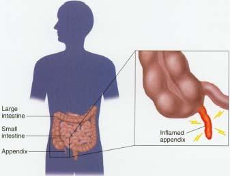 irritant APPENDICITIS an inflammation of the