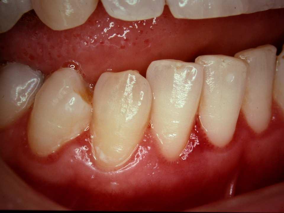 Clinically significant reductions in interdental gingivitis vs control