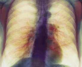 accumulation Activate production of enzymes which break down lung connective