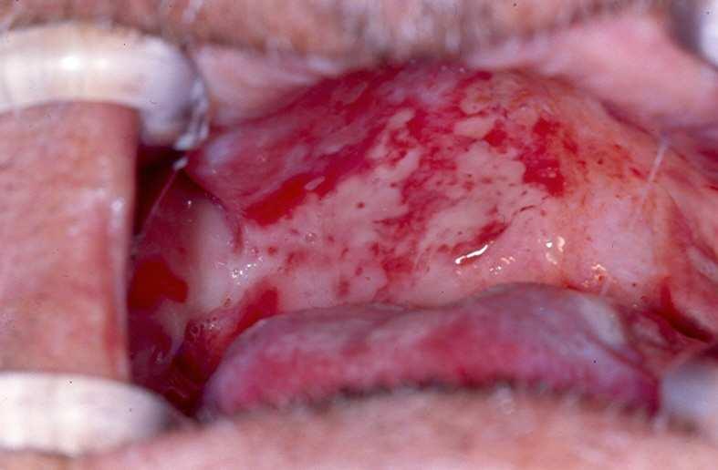 Pathogens Oral bacteria penetrate into