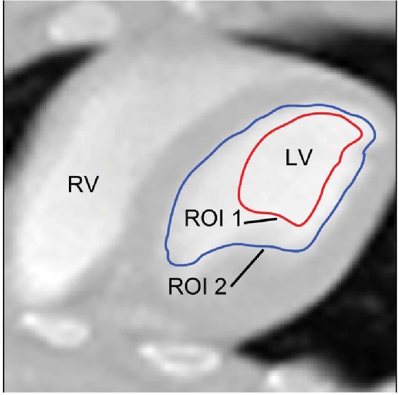 Bottom left: VRV (Right ventricle blood volume). Bottom right: V A (Left ventricle arterial blood volume). V A and V RV are the spill-in coefficients for the myocardium.