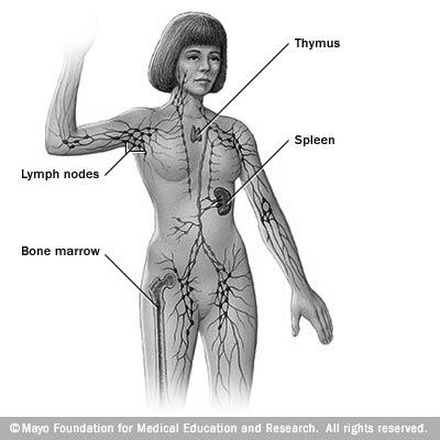 Lymphedema Lymphedema Inability to drain lymph fluid from the arm or legs
