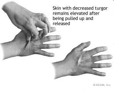 Skin Color (pallor or jaundice) Bleeding / Bruising Turgor Swelling