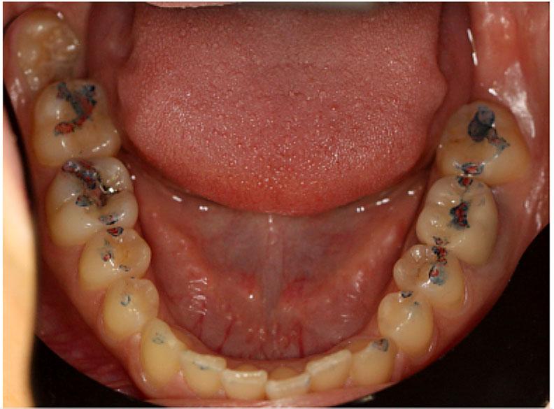 Occlusal scheme at Delta Besides study of occlusion the system