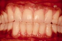 maxilla in the maximum intercuspation of the teeth.