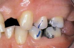 recording cuspal relation of the teeth is not
