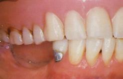 Interocclusal Records - Most accurate method requires use of stabilized occlusal rims.