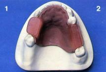 after performing the altered cast procedure, an auto-polymerizing acrylic resin base is
